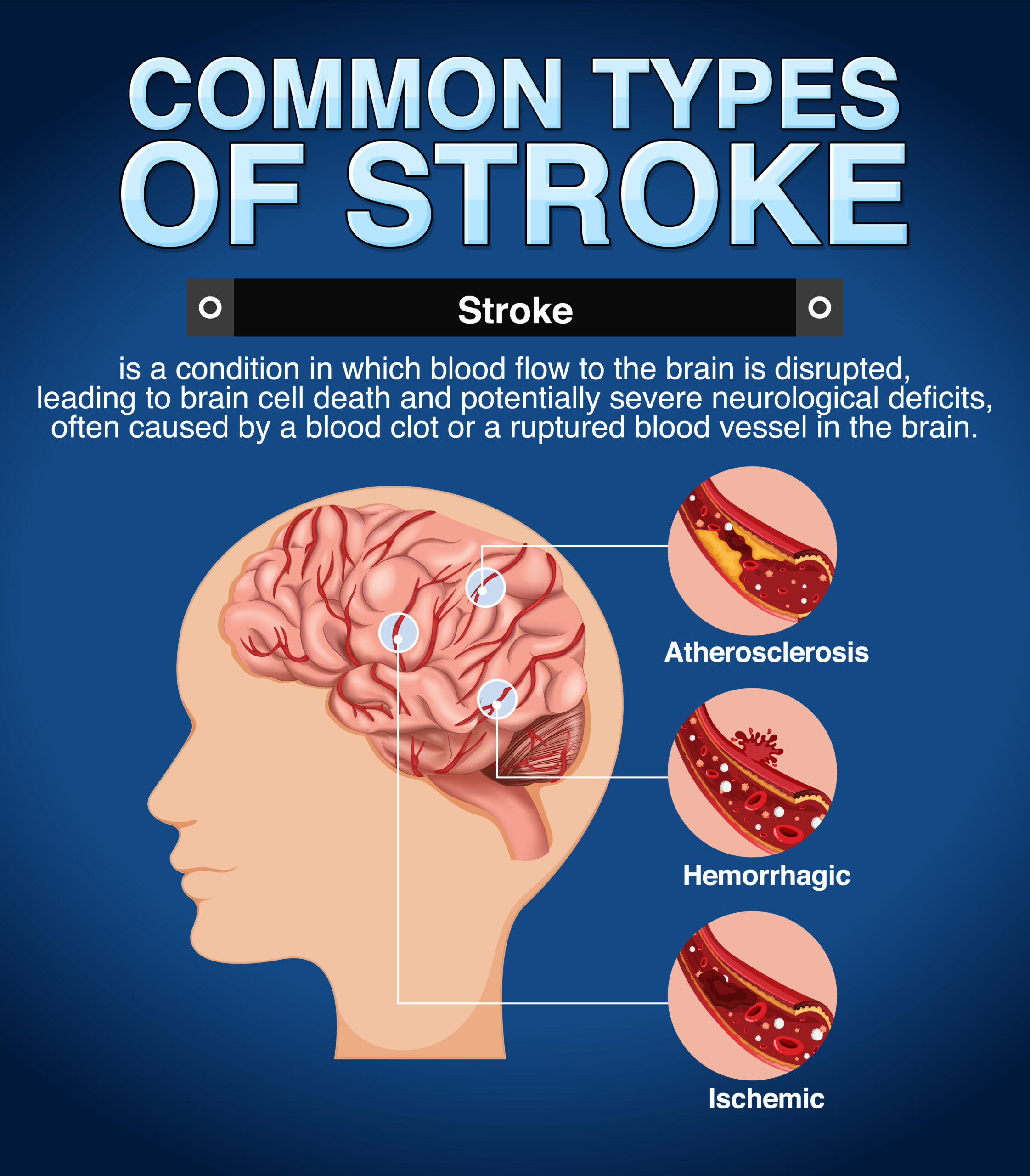 Common Types of Brain Stroke